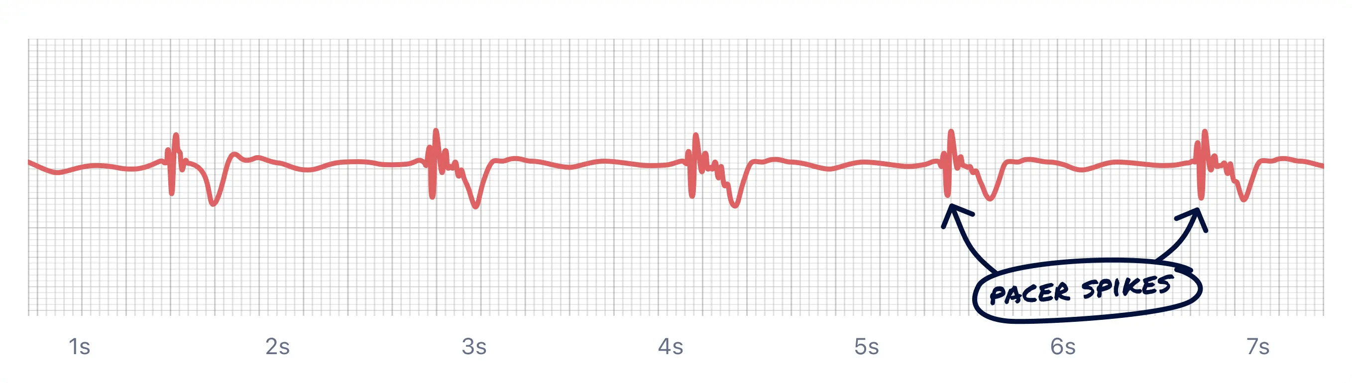 What Paced Rhythm Looks Like on Your Watch ECG Qaly